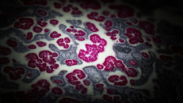 揭示浸润性腺癌ii级腺泡为主型的奥秘