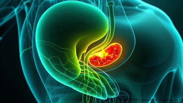 胆总管结石与胆管炎：警惕早期信号并寻求解决方案
