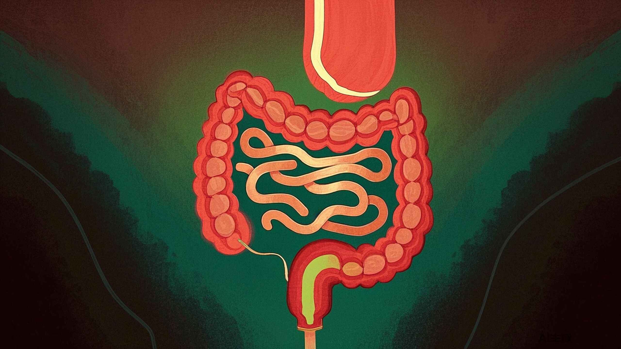 科普，肠<span style="color: #da4707">梗阻</span>：<span style="color: #da4707">消化道</span>中的幽灵，潜藏的威胁