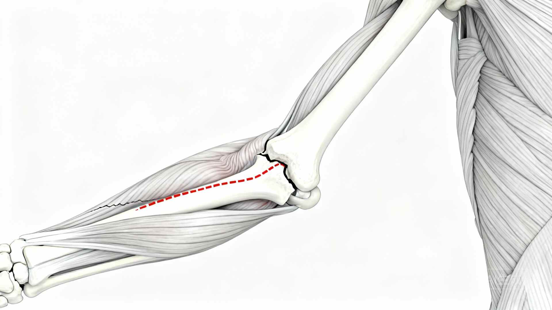 科普，麻醉领域在桡骨远端骨折手术中的应用封面图