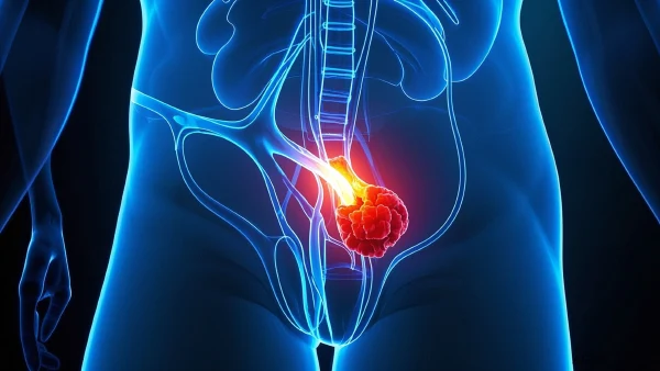 腹股沟疝:病因、诊断与治疗全解析