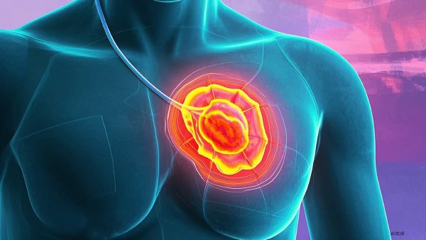 从乳腺结节到乳腺癌:一场隐秘的战役