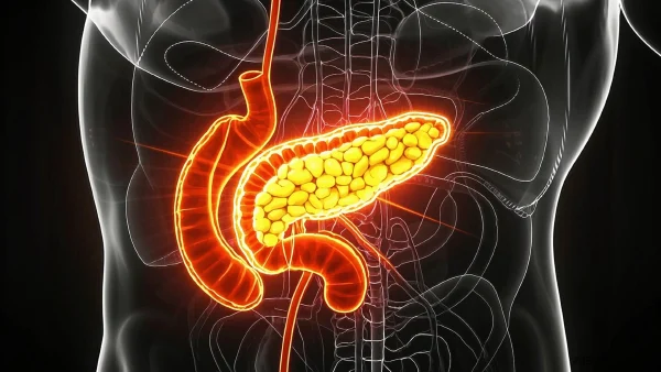 胰腺分裂:从诊断到治疗的全景之旅