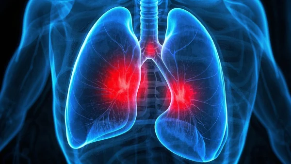 肺部感染的识别与健康管理：全面解析病因、预防与治疗