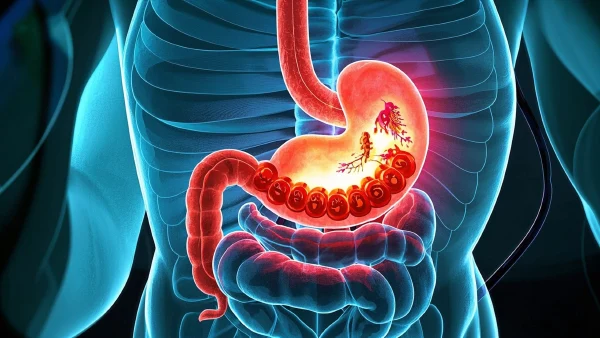 “胃”险重重：当结肠遭遇占位性病变的攻防战