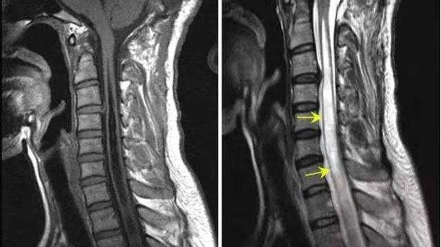 解密脊髓空洞症：探究脊髓中“黑洞”的潜在威胁