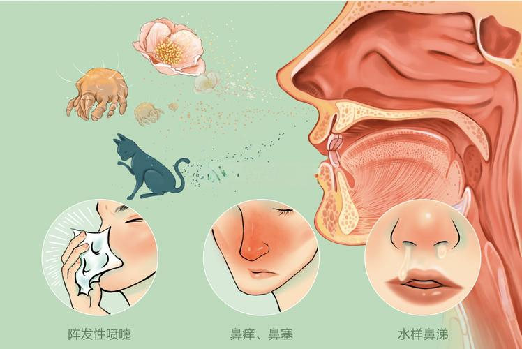 告别鼻炎：深入了解并科学预防过敏性鼻炎