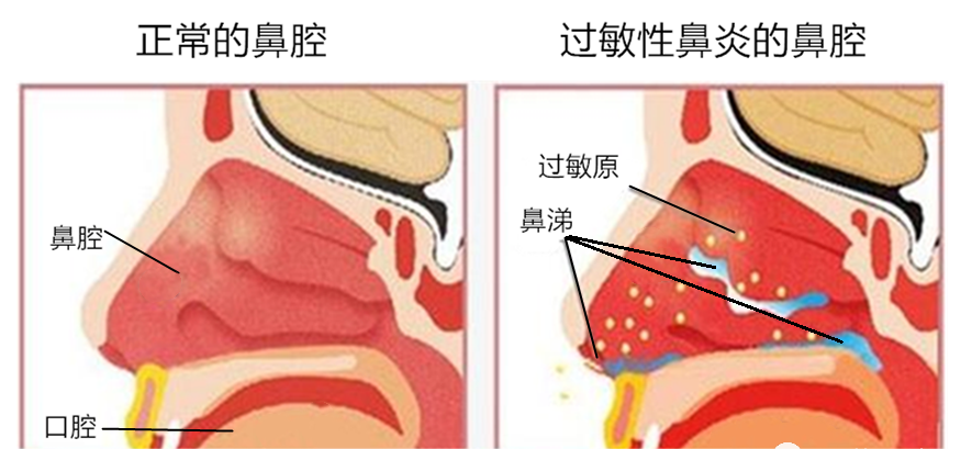 战胜过敏性鼻炎！了解药物治疗的秘密