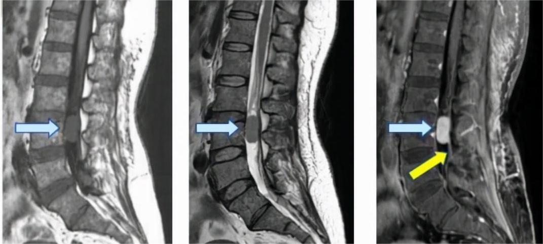 揭秘胸椎内的隐形杀手：椎管肿瘤
