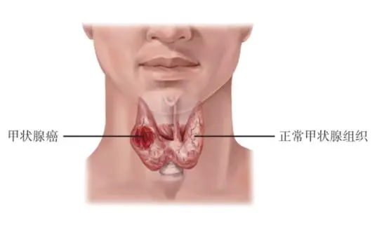 甲状腺癌你知道吗？——从临床诊断到日常预防