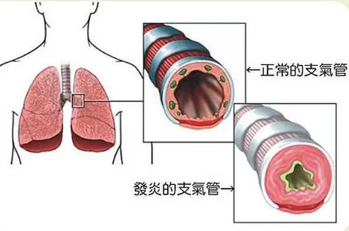 了解慢性支气管炎：从基础到治疗