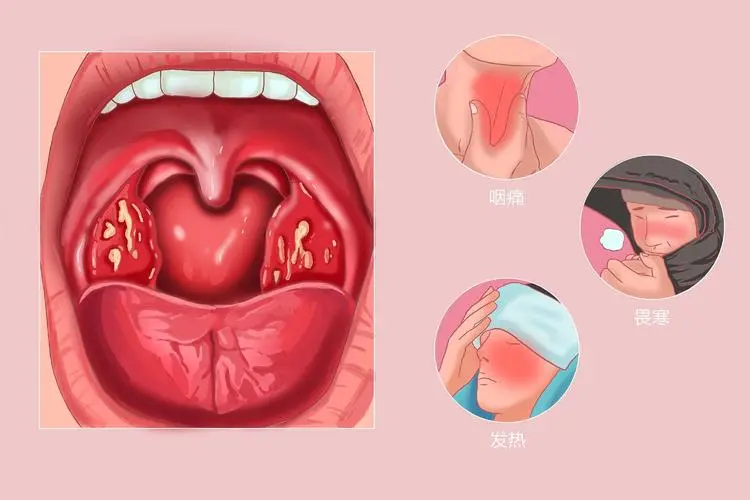 咽旁间隙感染及急性扁桃体炎的综合治愈与管理