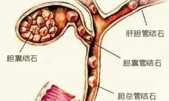 全面解析胆总管结石：从诊断到治疗的全方位指南