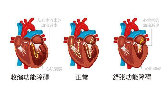 解开心衰之谜：如何预防心力衰竭