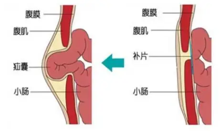 腹股沟疝修补术究竟有多重要？不容忽视！