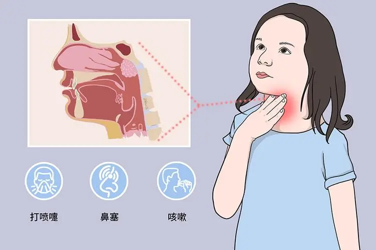 小儿急性上呼吸道感染：你需要了解的关键事实！