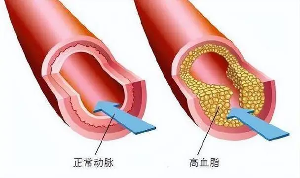 急性上呼吸道感染与高脂血症的综合管理