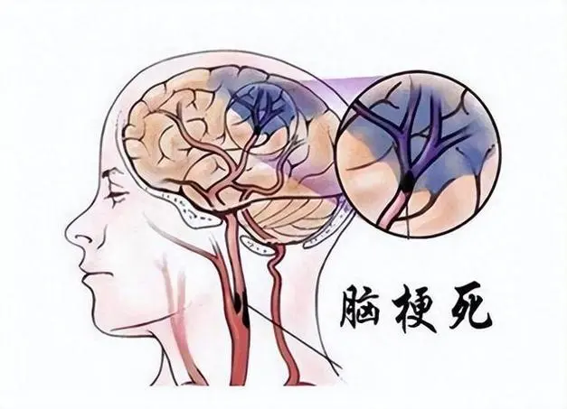 脑梗死：全面解析及科学管理