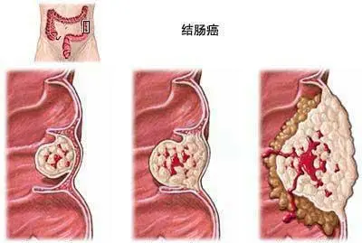 揭秘横结肠癌：从诊断到治疗的完整指南