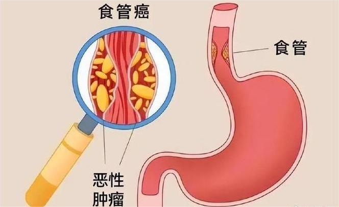 全面了解食管恶性肿瘤：从诊断到治疗