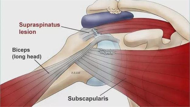 “肩袖损伤揭秘——你不知道的危害与预防！”