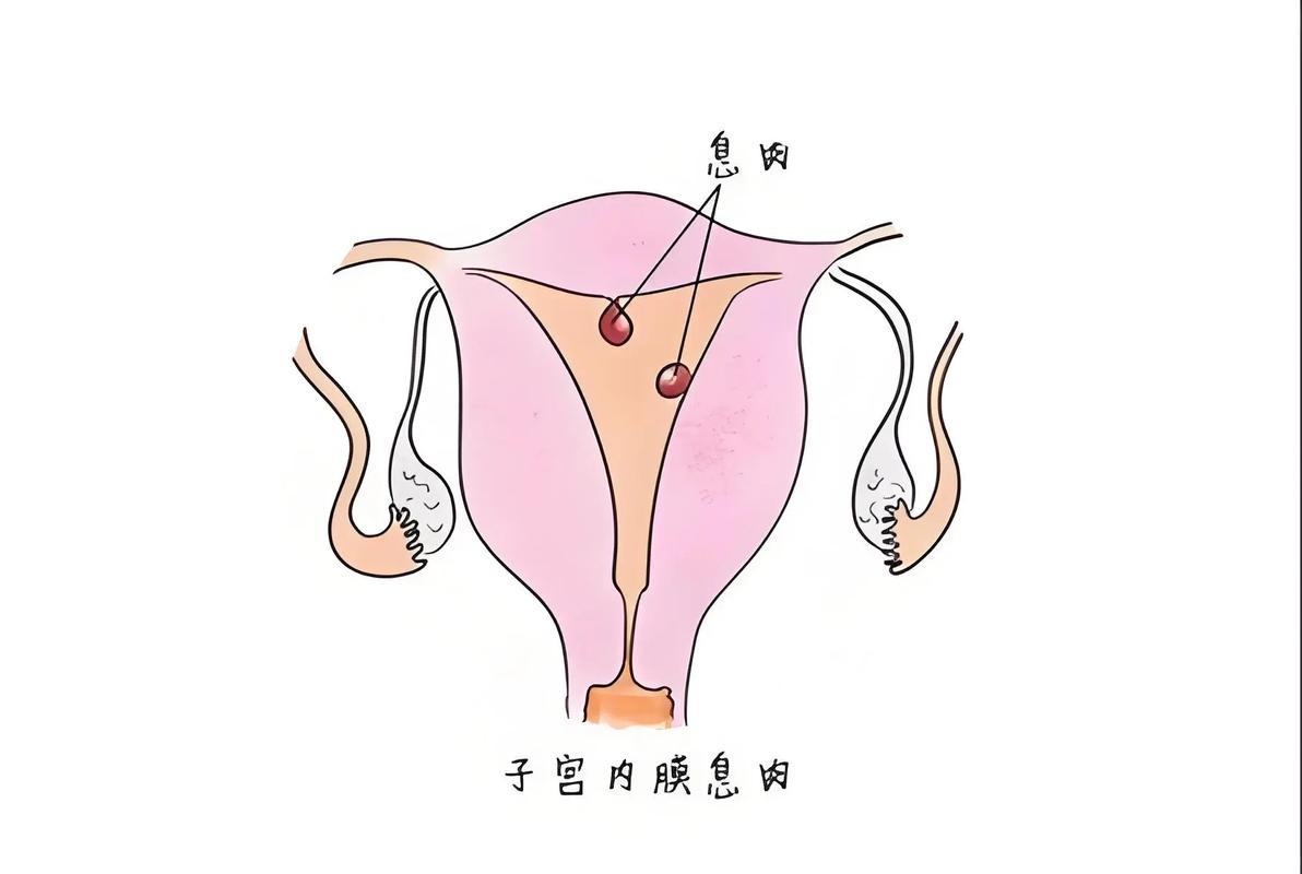 解密子宫内膜息肉：女性健康的隐形敌人