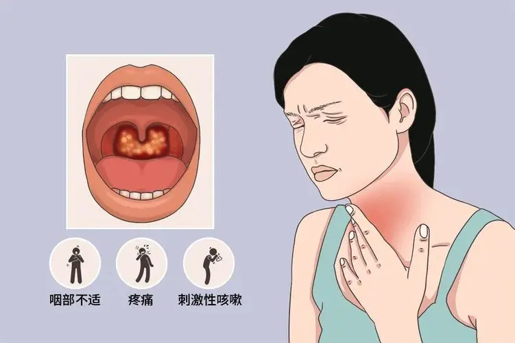 全面解读急性咽炎：病因、症状与治疗