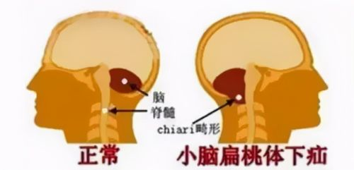 小脑扁桃体下疝畸形！脊髓空洞，让我们一探究竟