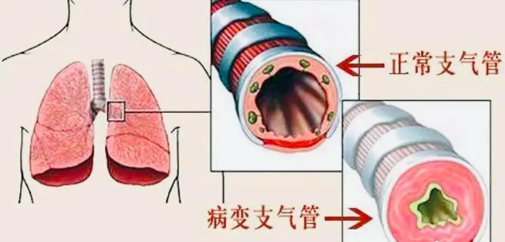 “隐藏在咳嗽背后的秘密——慢性支气管炎急性发作！”