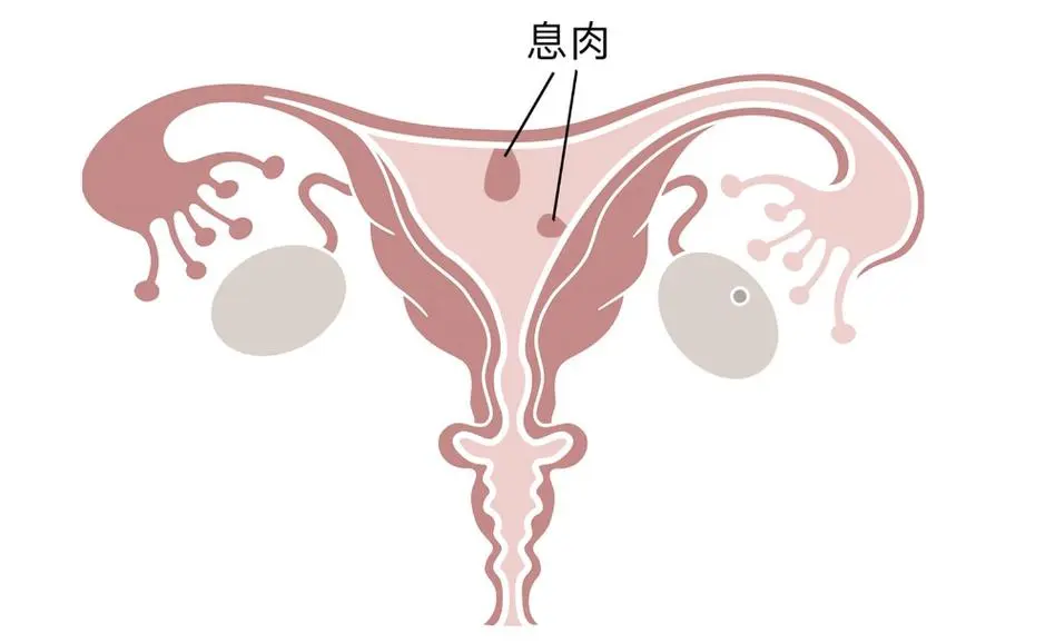 子宫内膜息肉手术成功展开！详细解析术前术后注意事项