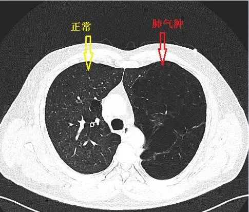 慢性支气管炎与肺气肿：从诊断到治疗的全面指南