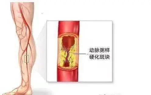 下肢动脉硬化闭塞症：诊断与管理全解析