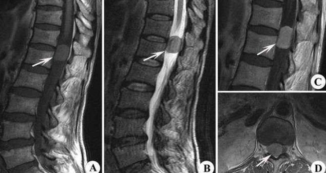 脊髓肿瘤：隐秘的“时间炸弹”如何应对与预防