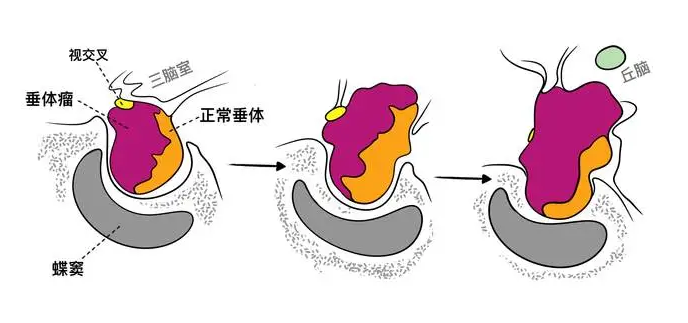 揭秘垂体瘤：从病因到治疗，全面了解这一脑内隐匿敌人