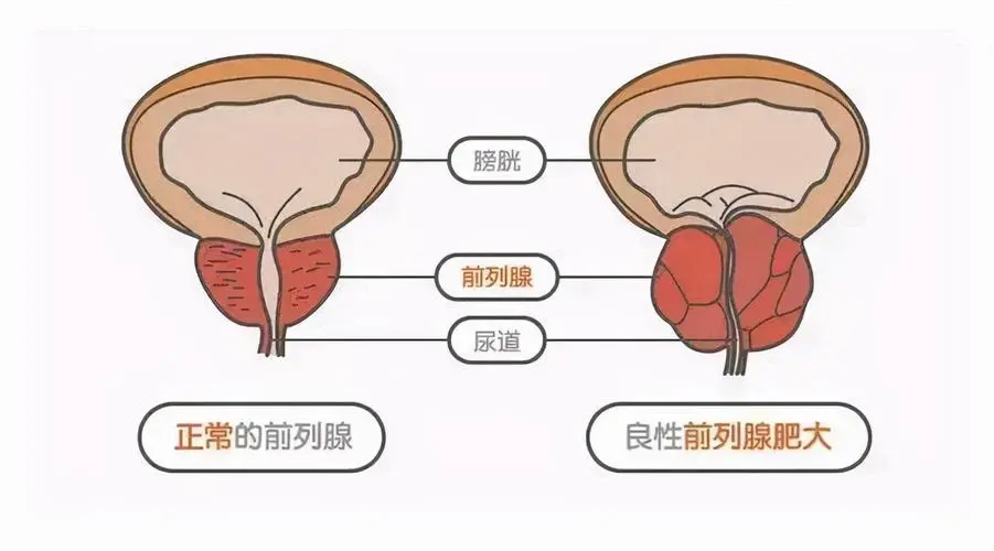 深度解析前列腺增生和膀胱结石：病因、治疗与预防全攻略