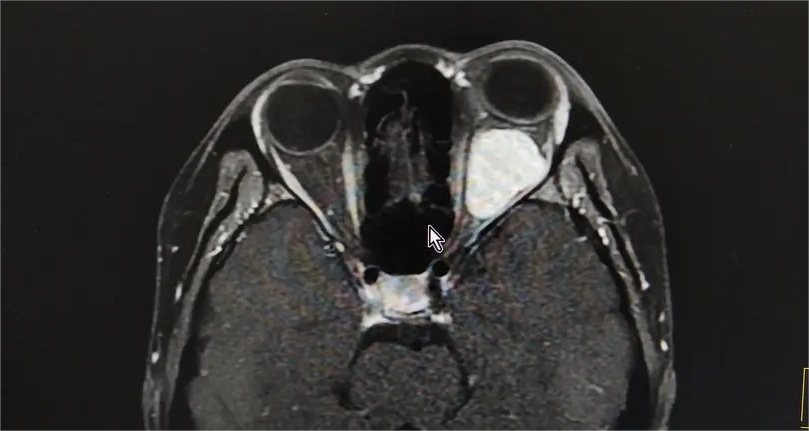 重视额叶与眼眶肿瘤的诊断与管理
