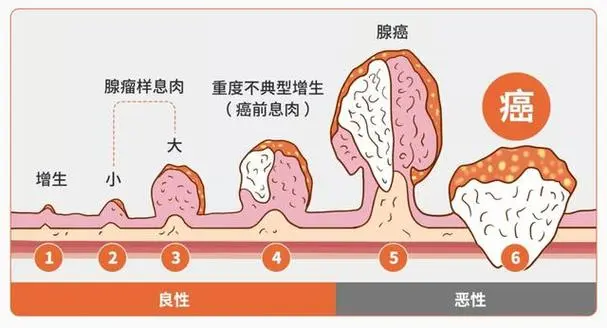 结肠息肉的全面解析：从诊断到治疗的科学管理