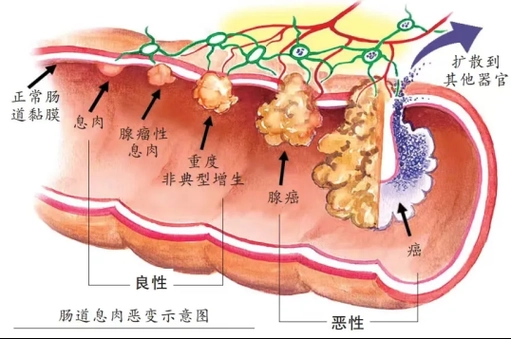 直肠癌的全面解析：从诊断到治疗