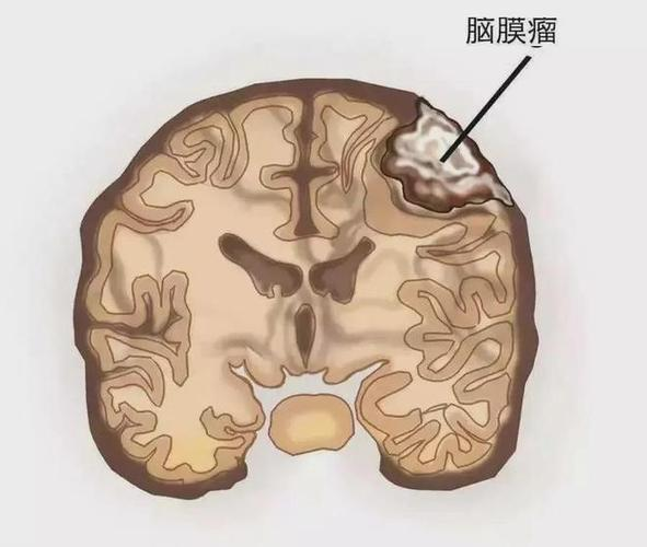 全面解析颅底占位性病变：诊断与治疗指南