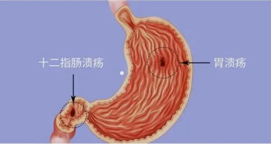 全面解析十二指肠穿孔：从诊断到治疗