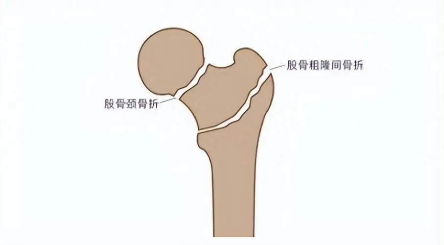 关注股骨粗隆骨折！老年人跌倒后不容忽视的骨折类型