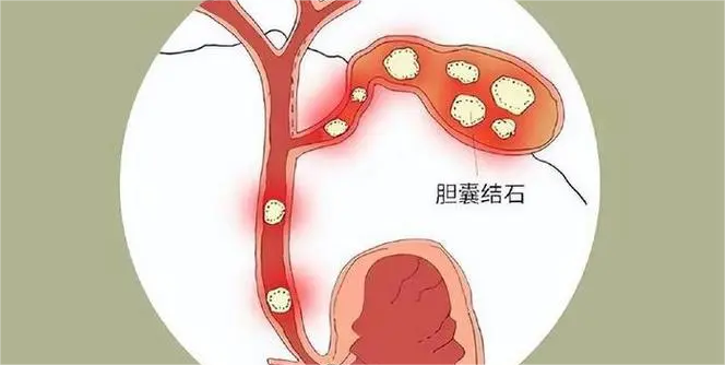 胆囊结石与慢性胆囊炎：病因、诊断、治疗与管理