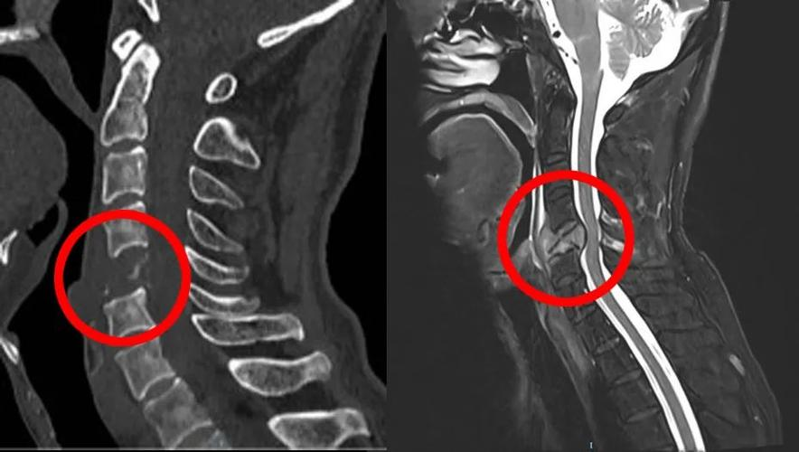 颈椎肿瘤：从临床表现到预防的一全面解析