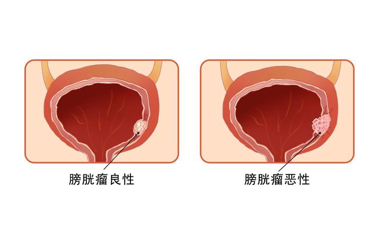 揭开膀胱肿瘤的神秘面纱——生命的隐形威胁！